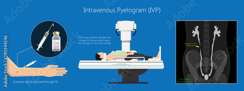 Intravenous pyelogram IVP examination x-ray for bladder kidney ureters disease problem