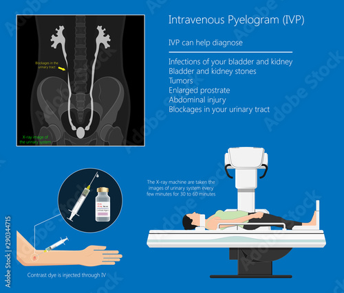 Intravenous pyelogram IVP examination x-ray for bladder kidney ureters disease problem