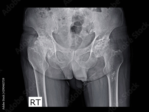 Film x-ray hip radiograph show femoral head collapse form bone infarction or avascular necrosis (AVN) or Osteonecrosis (ON) disease.  Medical imaging concept
