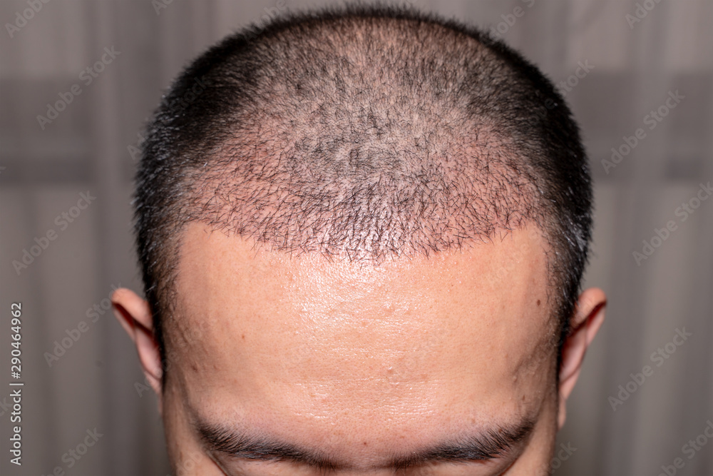 Close up view of a man's head with hair transplant surgery. Bald head of  hair loss treatment. Stock Photo | Adobe Stock