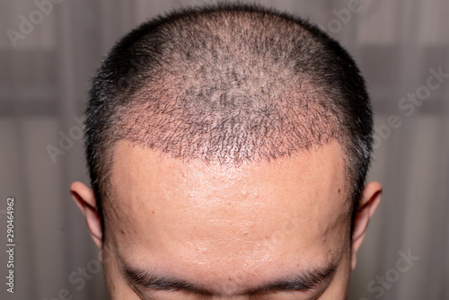 Close up view of a man's head with hair transplant surgery. Bald head of hair loss treatment.