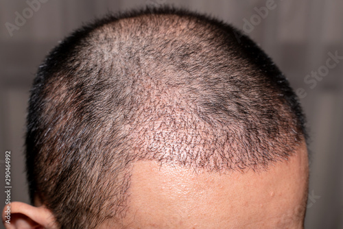 Close up view of a man's head with hair transplant surgery. Bald head of hair loss treatment.