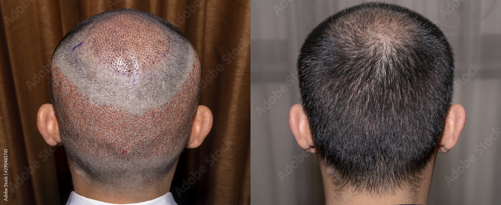 Back view of a man's head with hair transplant surgery with a receding hair  line. - Before and After Bald head of hair loss treatment. Stock Photo |  Adobe Stock
