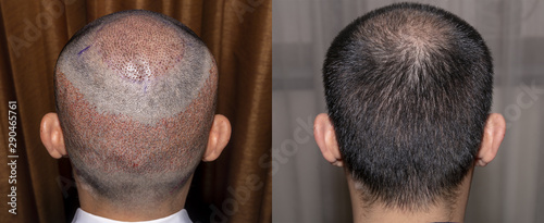 Back view of a man's head with hair transplant surgery with a receding hair line. - Before and After Bald head of hair loss treatment.