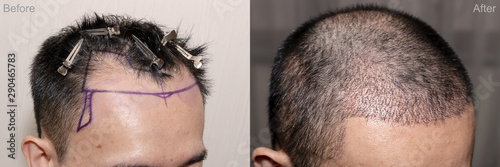 Top view of a man's head with hair transplant surgery with a receding hair line. - Before and After Bald head of hair loss treatment. photo