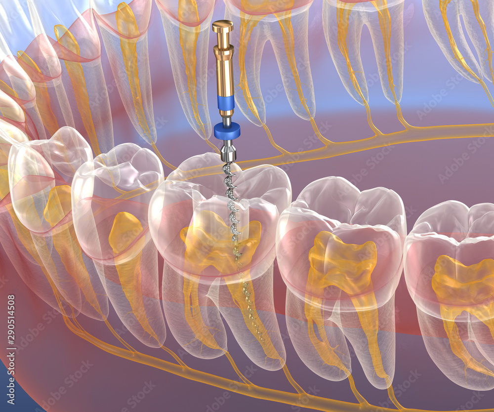 Endodontic root canal treatment process. Medically accurate tooth 3D illustration. - obrazy, fototapety, plakaty 