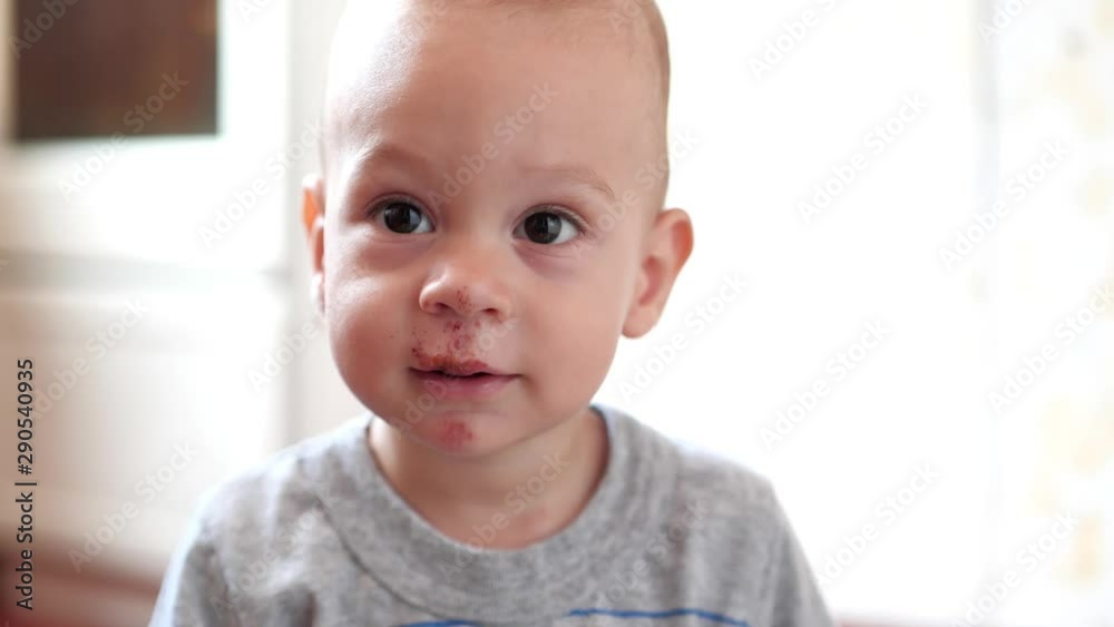 Slow motion, Baby boy with scratch of lips, nose and chin looks on his parents. Real injury after falling out of perambulator. Video may be used for family or domestic violence Slow motion, Baby boy with scratch of lips, nose and chin looks on his parents. Real injury after falling out of perambulator. Video may be used for family or domestic violence