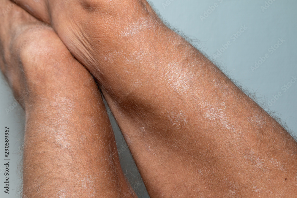 Large plaque parapsoriasis on caucasian man legs Large plaque parapsoriasis on caucasian man legs