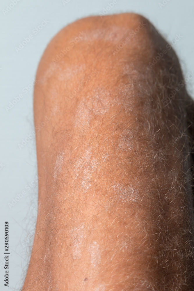 Fototapeta premium Large plaque parapsoriasis on caucasian man legs