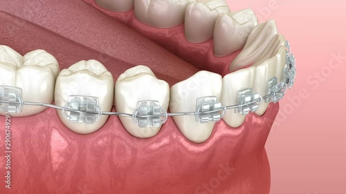 Mandibular jaw and Clear braces. Medically accurate dental 3D animation photo
