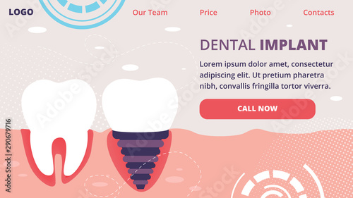 Dental Implant Stomatology Orthodontics Procedure.