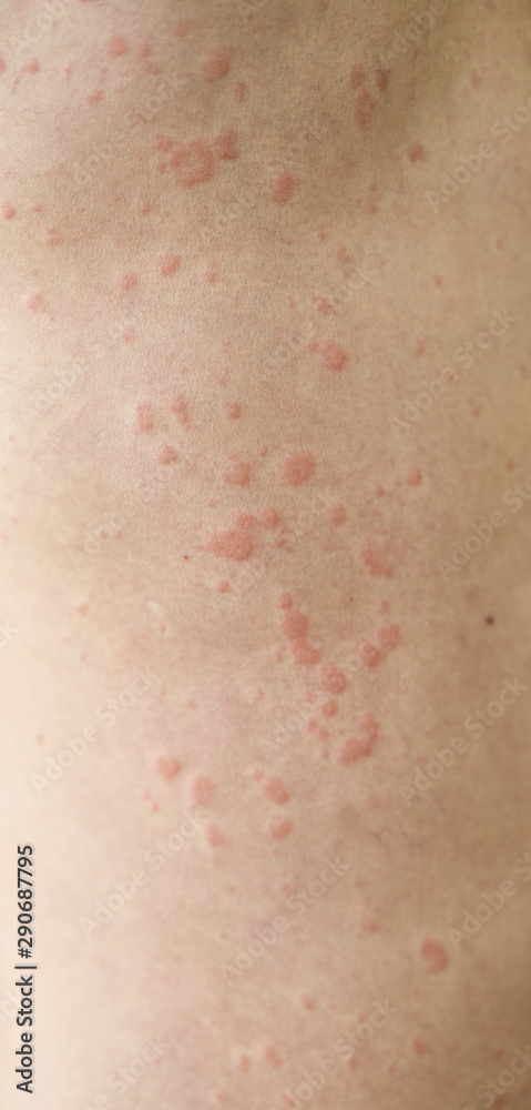 Skin imperfection. Skin allergy. Urticaria disease. Red spots on the skin. Skin imperfection. Skin allergy. Urticaria disease. Red spots on the skin.