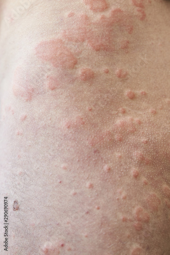 Skin imperfection. Skin allergy. Urticaria disease. Red spots on the skin.