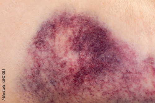 Close up of a hematoma on the arm of woman. photo