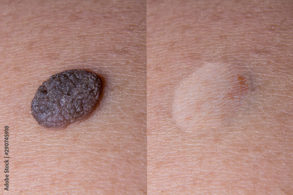 Naklejka premium Mole removal inborn
