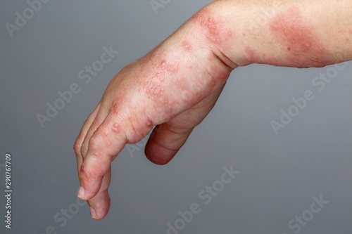 Tableau sur toile Shingles, Zoster or Herpes Zoster symptoms on arm