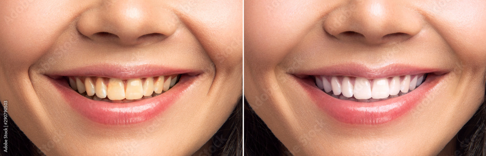 Close-up Of Smiling Woman Teeth Before And After Whitening  - obrazy, fototapety, plakaty 