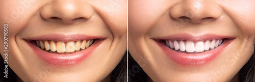 Close-up Of Smiling Woman Teeth Before And After Whitening 