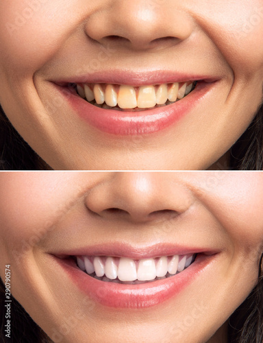 Close-up Of Smiling Woman Teeth Before And After Whitening 