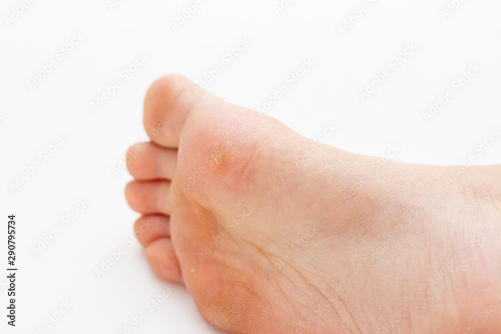 corns on the foot isolated on white background corns on the foot isolated on white background