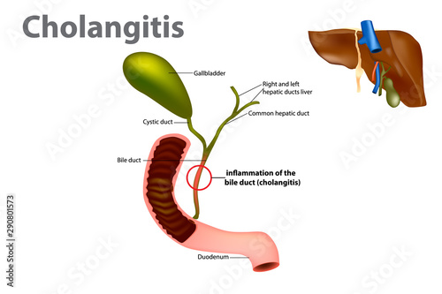 Inflammation of the bile duct (Ascending cholangitis or acute cholangitis)