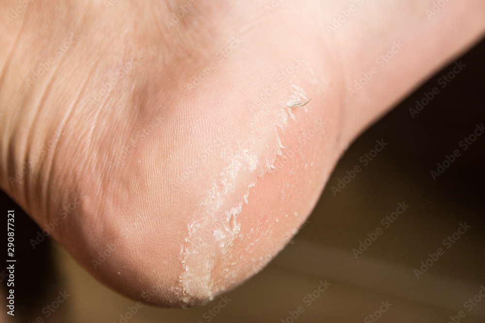 Fototapeta premium heel disease close up