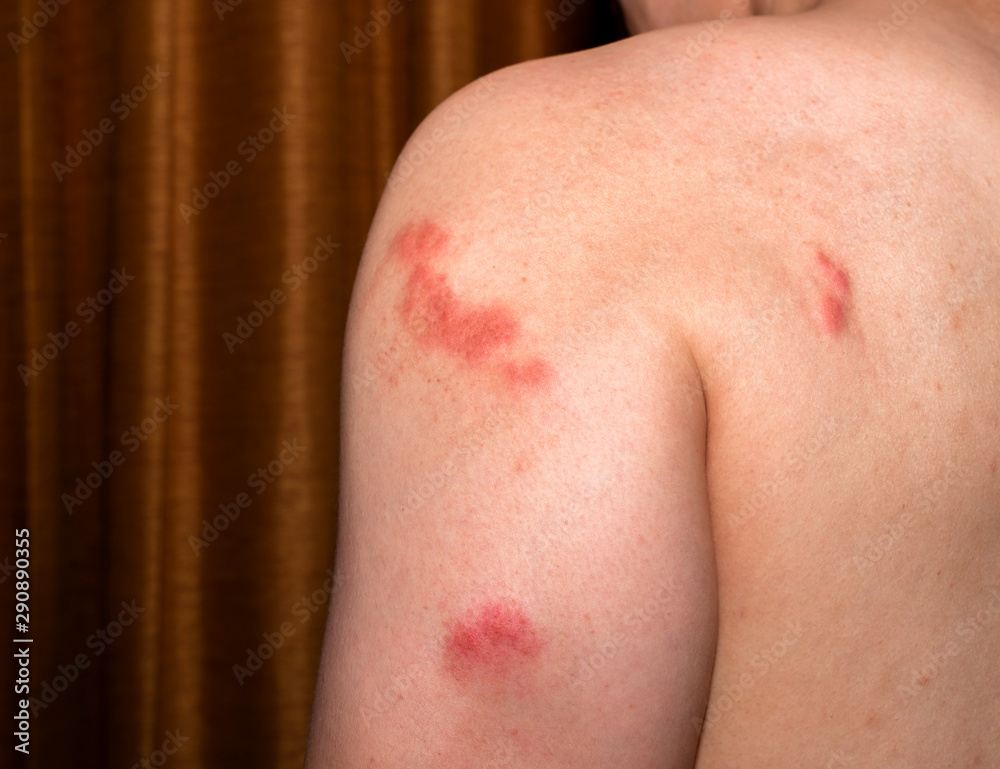 Red Spot Inflammation skin cause by Insect bite. Skin rash and allergy from mosquito bite. Red Spot Inflammation skin cause by Insect bite. Skin rash and allergy from mosquito bite.