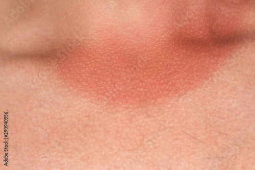 Fotografie Closeup view of male body with sunburned red skin in area of neck
