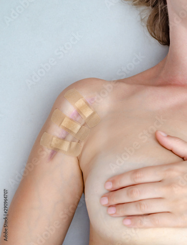 Fototapeta Naklejka Na Ścianę i Meble -  Close up of female shoulder with a scar after install a metal plate bone fracture surgically. Wound is sealed with a medical plaster.