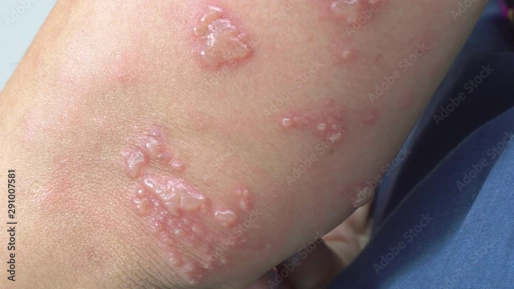 Shingles, Zoster or Herpes Zoster symptoms on arm Shingles, Zoster or Herpes Zoster symptoms on arm