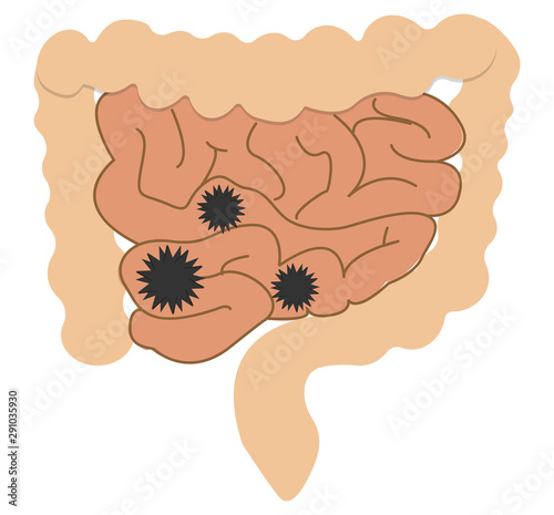 Colic in the gut.