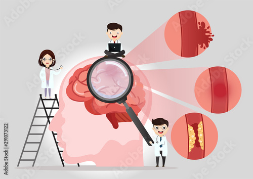 Scientific medical illustration of human brain stroke illustration