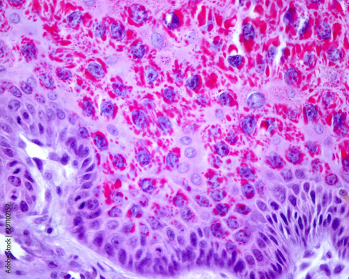 Obraz na płótnie Skin. Molluscum contagiosum