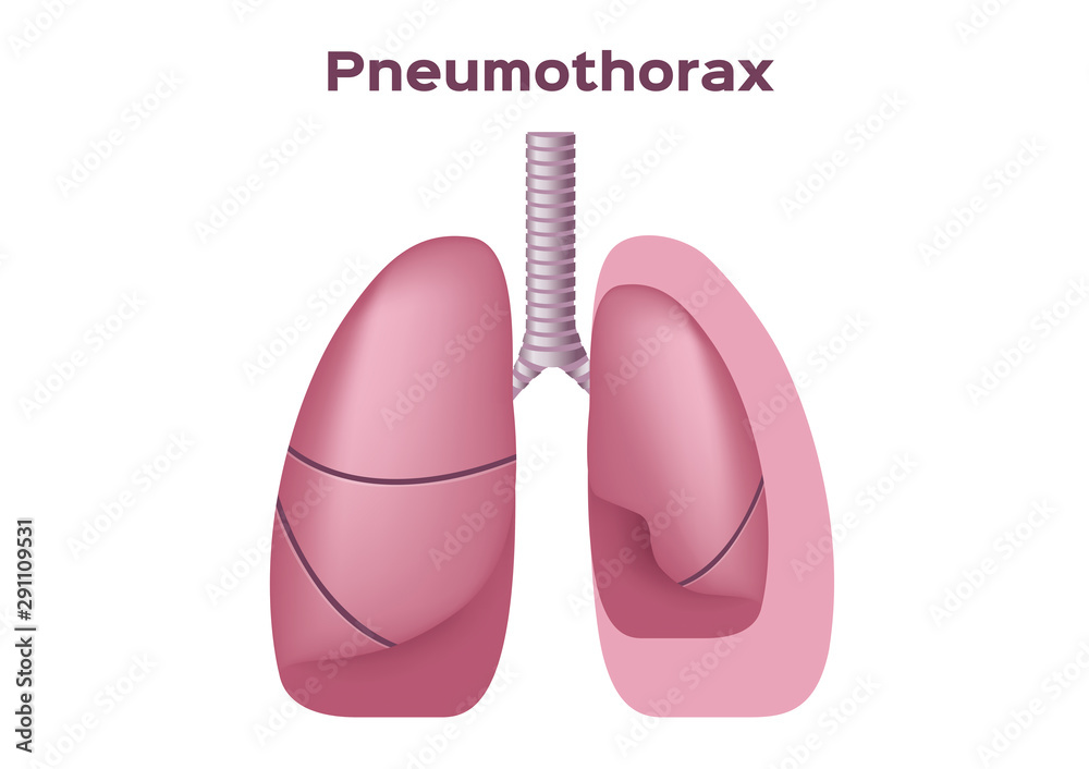 symptoms of pneumothorax lung vector symptoms of pneumothorax lung vector