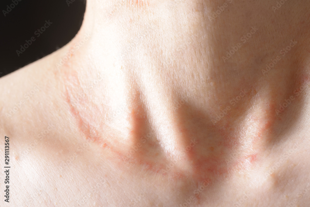 Fototapeta premium 皮膚病の女性