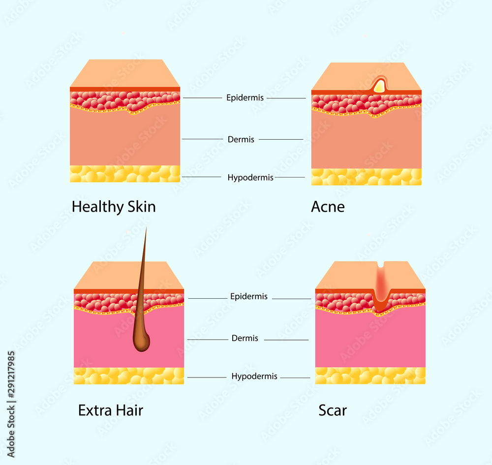 Vector illustration of types of skin problems isolated Stock Vector ...