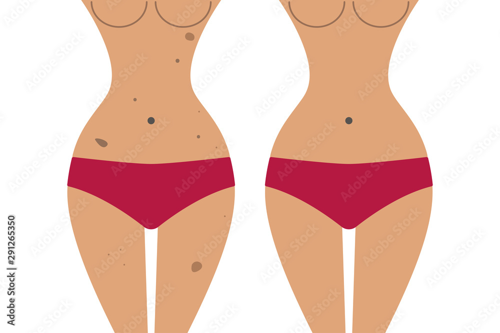 woman with hyperpigmentation woman with hyperpigmentation