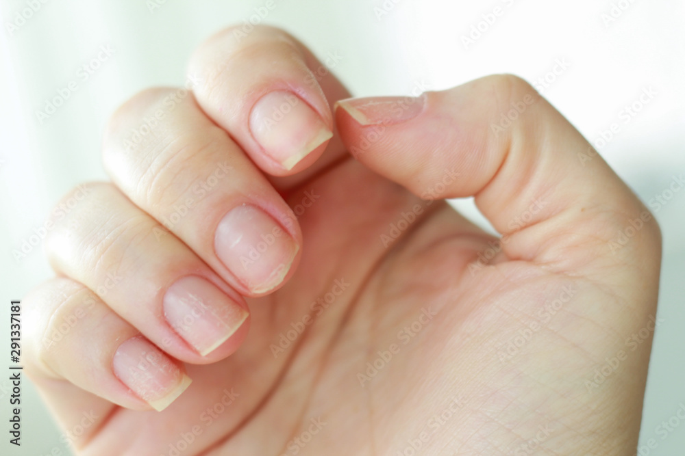 woman hand with brittle weak nails and white spots - obrazy, fototapety, plakaty 