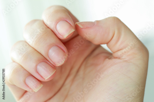 woman hand with brittle weak nails and white spots photo