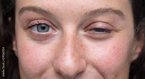 close up on blue eyes girl face with one half closed eye, Myasthenia gravis (MG) disease