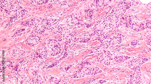 Breast cancer histology (core biopsy): Microscopic image (photomicrograph) of an infiltrating (invasive) ductal carcinoma, detected by screening mammogram. H & E stain.