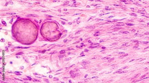 Stereotactic brain biopsy smear cytology of a meningioma, a benign brain tumor of the meninges, showing fascicles of spindle cells with psammoma bodies. photo