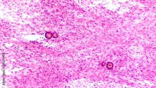 Stereotactic brain biopsy smear cytology of a meningioma, a benign brain tumor of the meninges, showing fascicles of spindle cells with psammoma bodies. photo