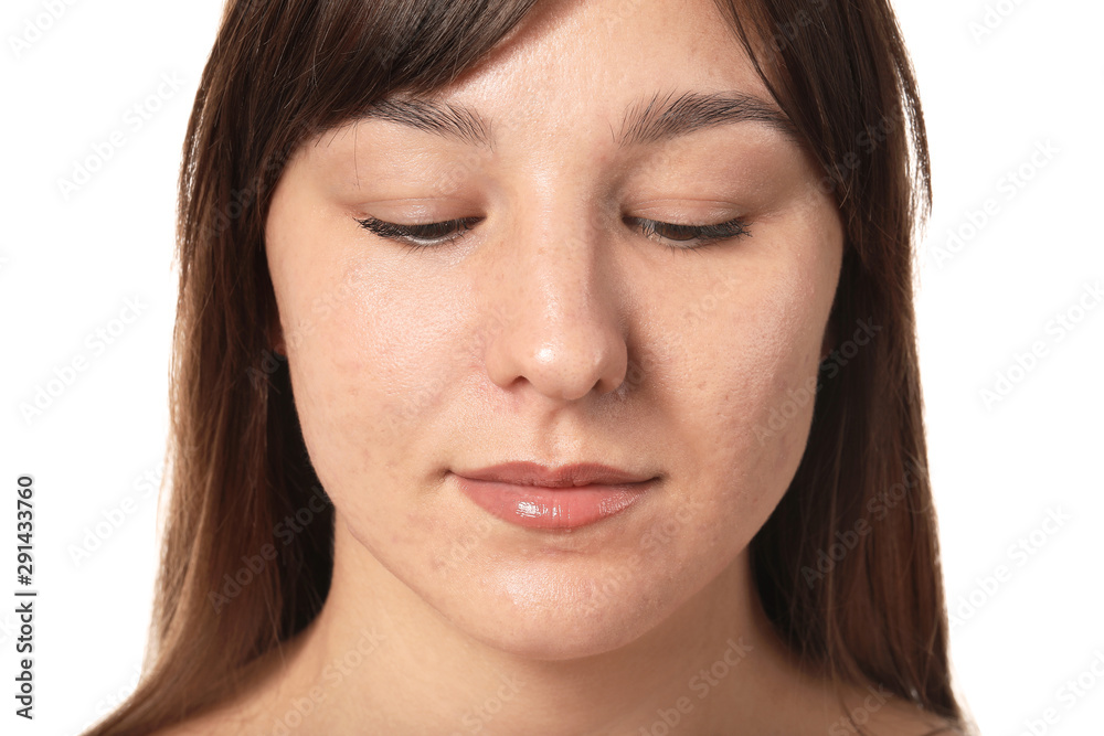 Young woman with acne problem on white background Young woman with acne problem on white background