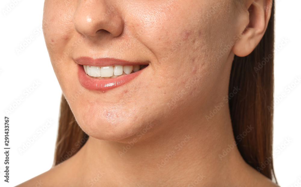 Obraz premium Young woman with acne problem on white background, closeup