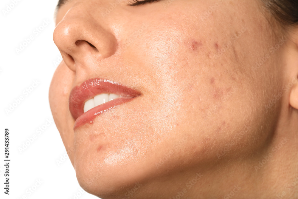 Young woman with acne problem on white background, closeup Young woman with acne problem on white background, closeup
