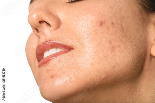 Young woman with acne problem on white background, closeup