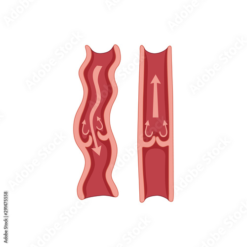 Vector varicose vein and normal vein. Varicose vein.