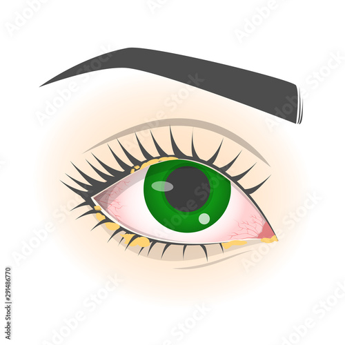 Conjunctivitis symptoms. Pink eye disease, infection and allergy