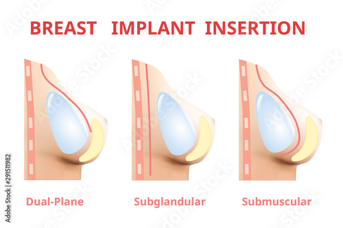 Breast implant insertion, Breast surgery silicone, 3D Realistic design Vector.
